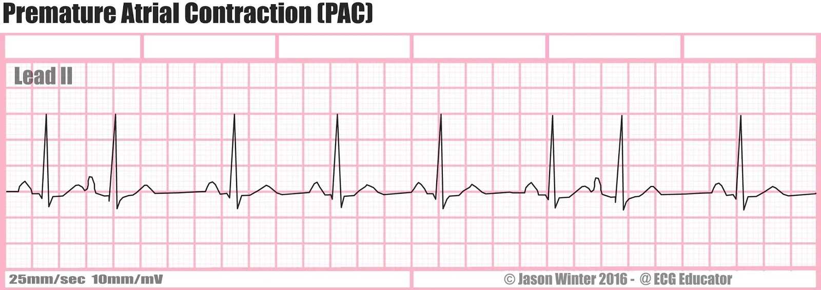 Premature Atrial Contractions (PAC)
